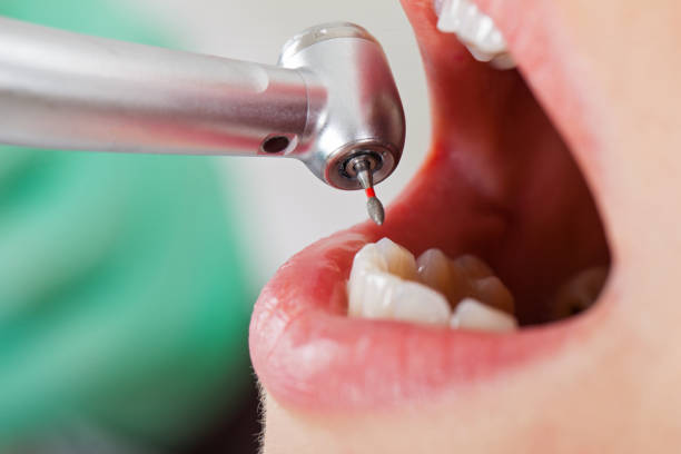 Best Emergency Root Canal Therapy in Henderson, LA